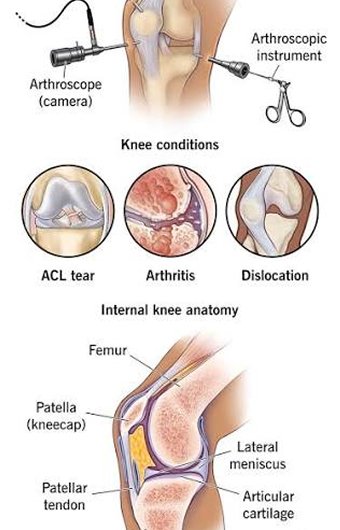 Knee Arthroscopy
